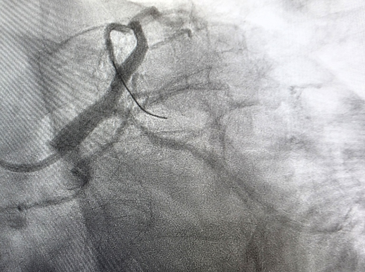 Coronary angiography image, view 1