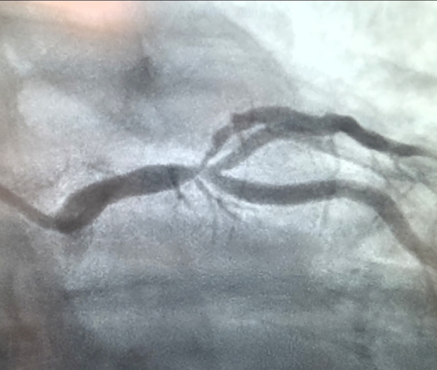 Coronary angiography image, view 2