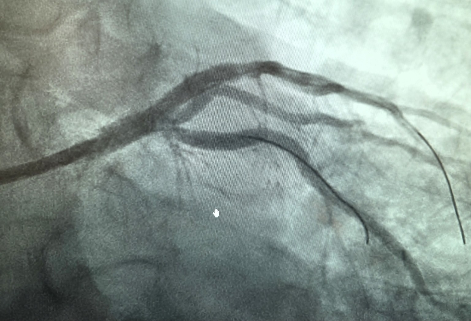 Coronary angiography image, view 3