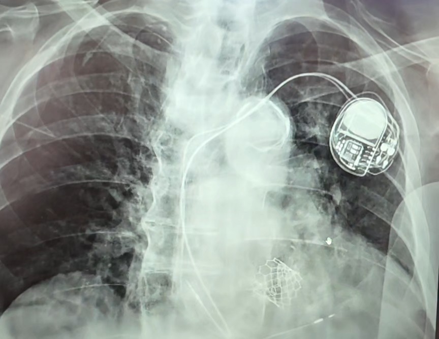 Chest imaging still showing cardiac devices